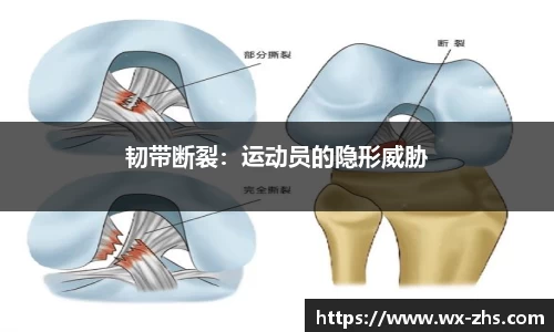 韧带断裂：运动员的隐形威胁
